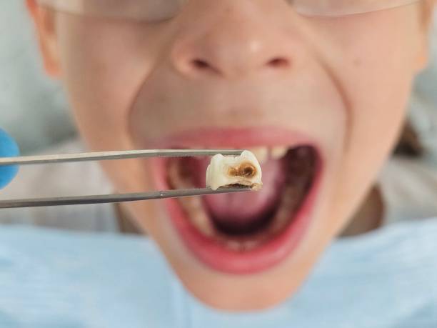 Best Emergency Dental Care for Abscessed Tooth in Lakemore, OH