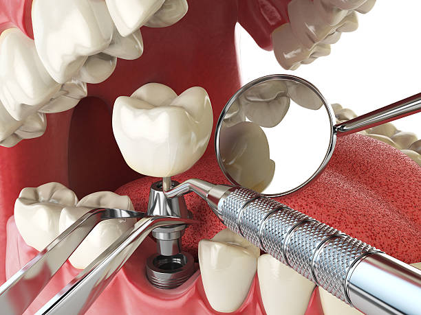 Best Broken or Cracked Tooth Emergency Dentist in Lakemore, OH